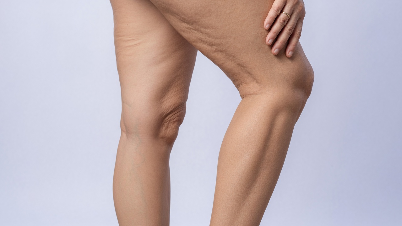 How Do You Fix Skin Laxity?